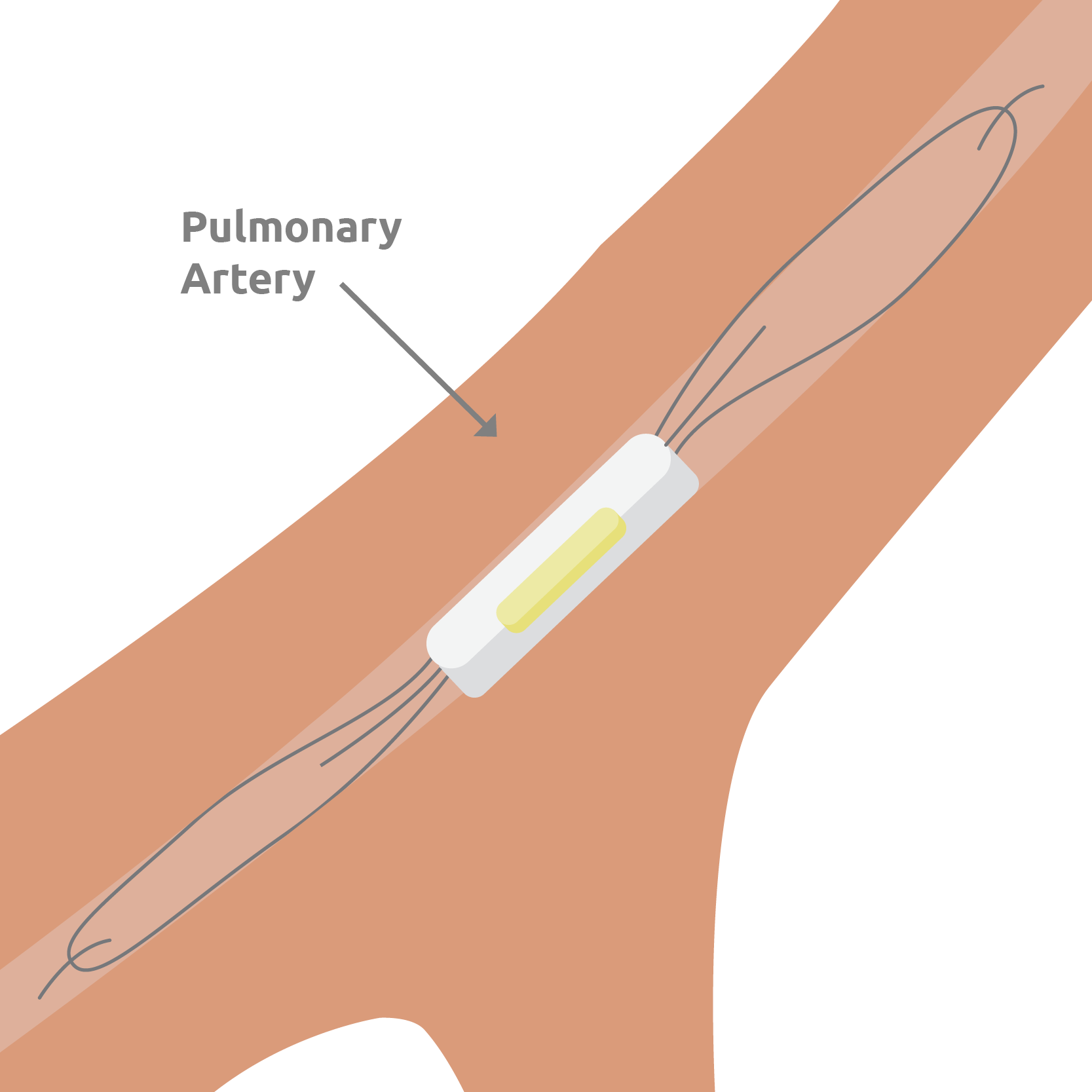 CardioMEMs